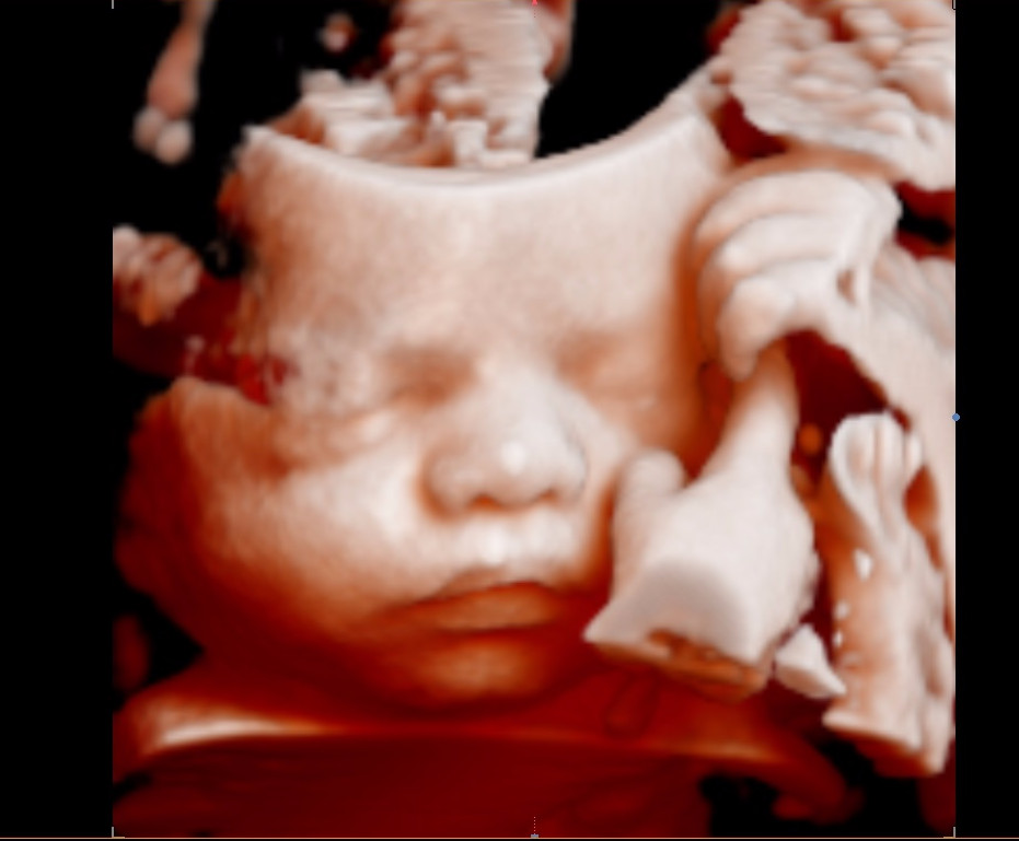 Premium Early Gender & 5D/4D/3D Baby Ultrasound - Price Beat Guara
