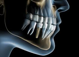Dental Implants Bundoora, Watsonia, Kingsbury, Macleod, Plenty & Lalor