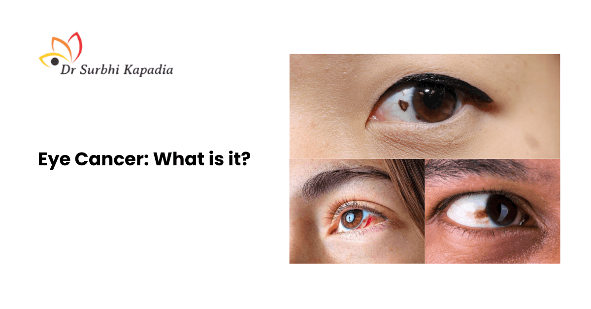 Eye Cancer: What is it? | Dr. Surbhi Kapadia