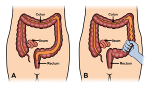 Effective Homeopathy for IBS Treatment at Dr. Singhal Homeo