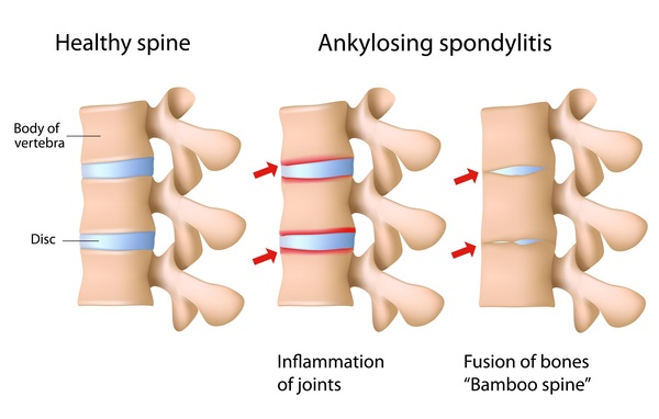 Get the Best Ankylosing Spondylitis Treatment in Homeopathy