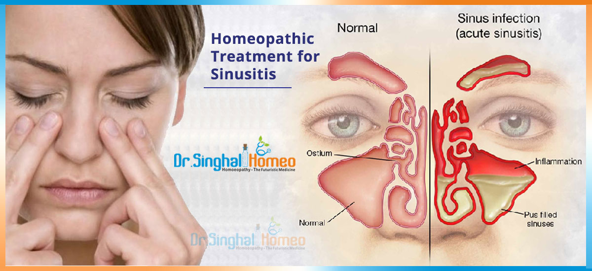 Get Effective Homeopathic Treatment for Sinusitis in India at the Best Cost