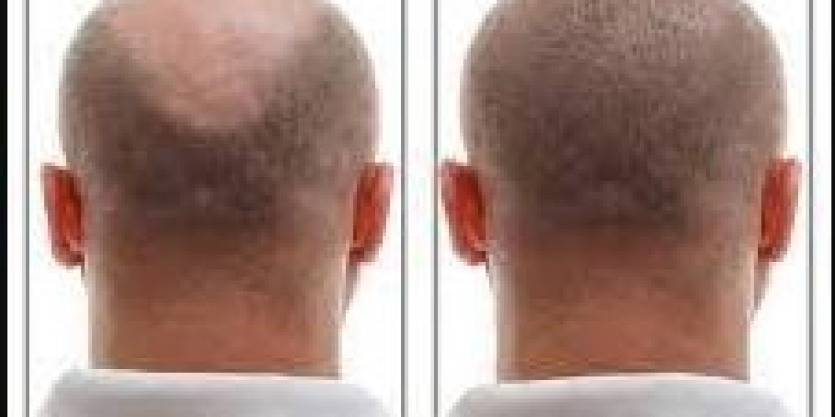Hair Restoration near Me: A Comprehensive Guide to Hair Transplant and Regrowth in Frisco, TX