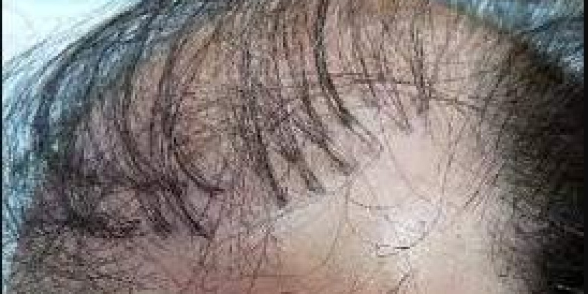 Hair Plugins near Me, FUE Hair Transplant near Me, and Regrow Hair near Me: A Comprehensive Guide