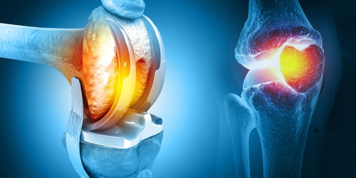 Comprehensive Guide to Knee Replacement Surgery: Everything You Need to Know