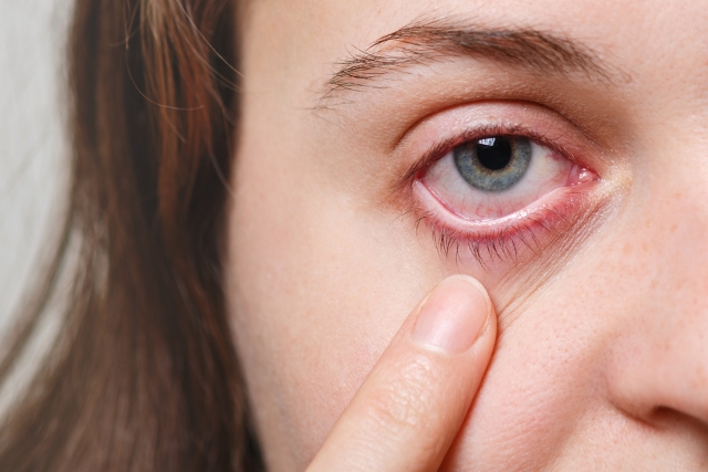 Conjunctivitis Outbreak: How to Prevent and Treat During Monsoon