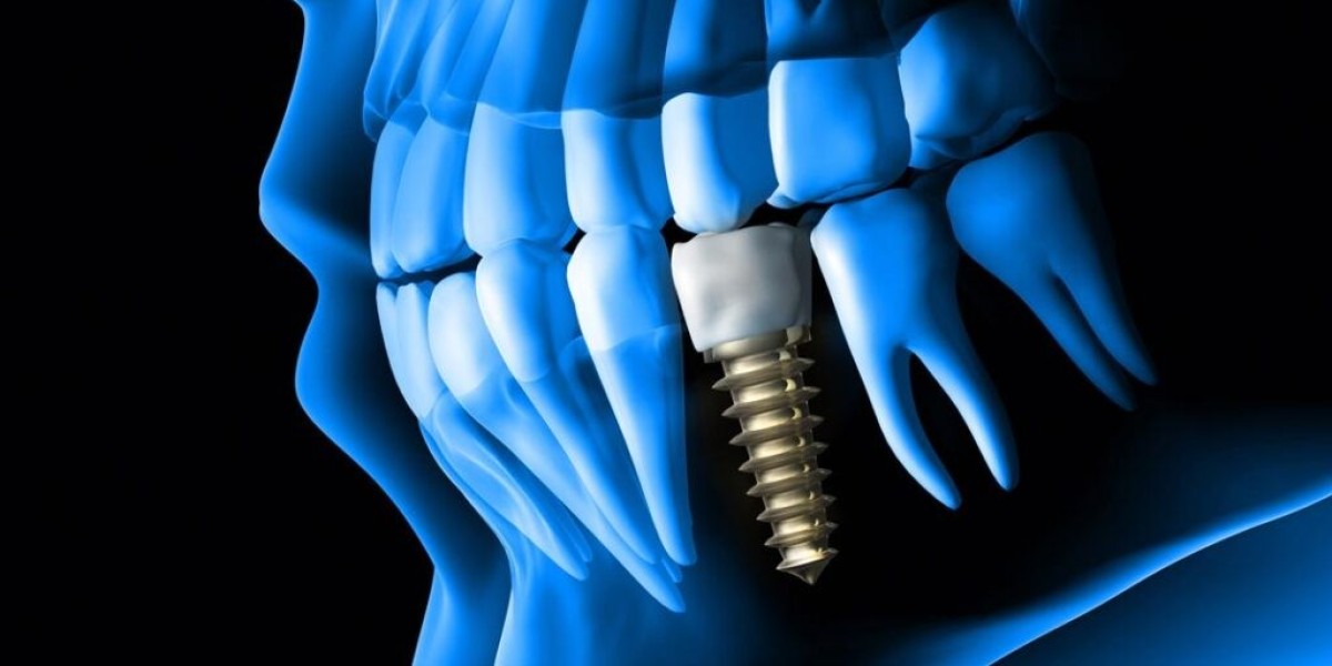 Top Rated Dental Implant in Dubai: Your Path to a Perfect Smile
