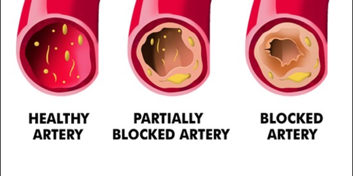Arterial Blockages - Causes & Ayurvedic Treatment