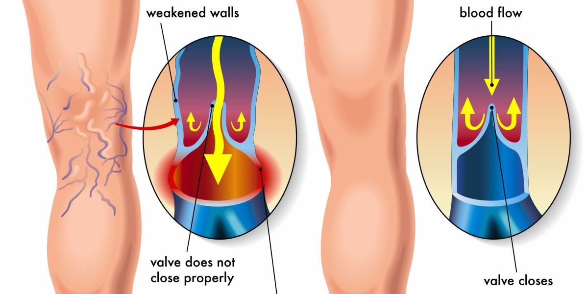 Vein Chronicles: Navigating the Depths of Varicose Vein Discoveries