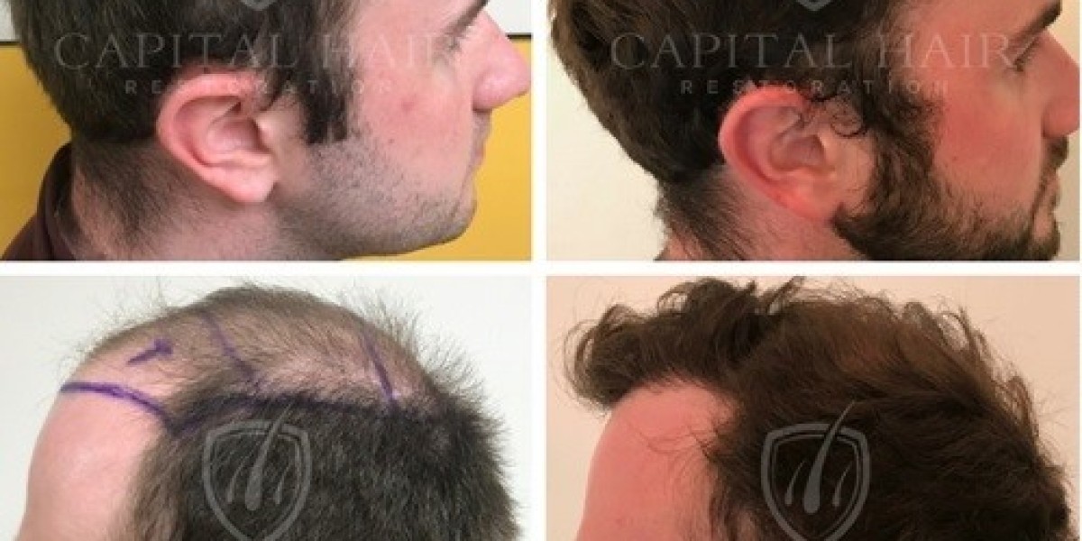 Budgeting For Confidence Exploring Hair Transplant Cost Factors In The UK
