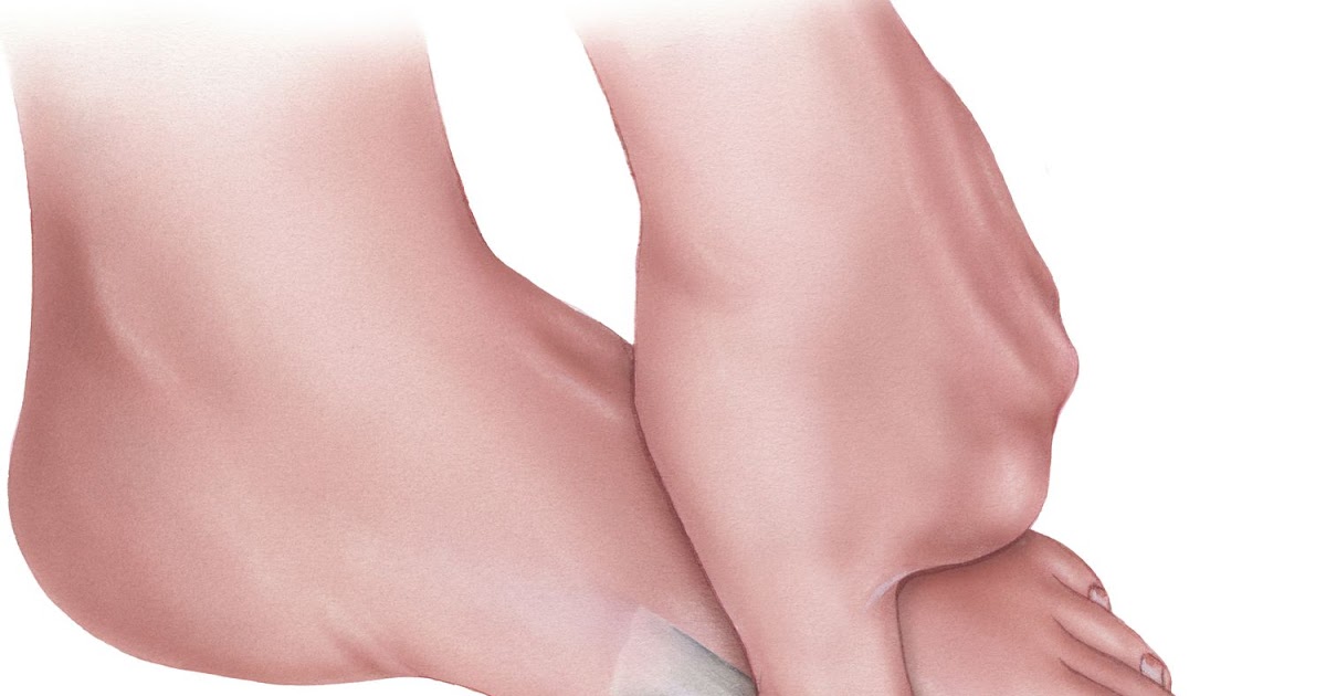 Understanding and Treating Hallux Rigidus: A Comprehensive Guide