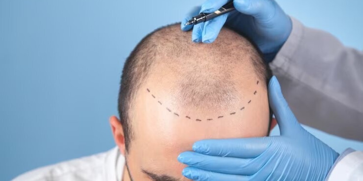 Hair Transplant Lower Hairline: A Comprehensive Guide