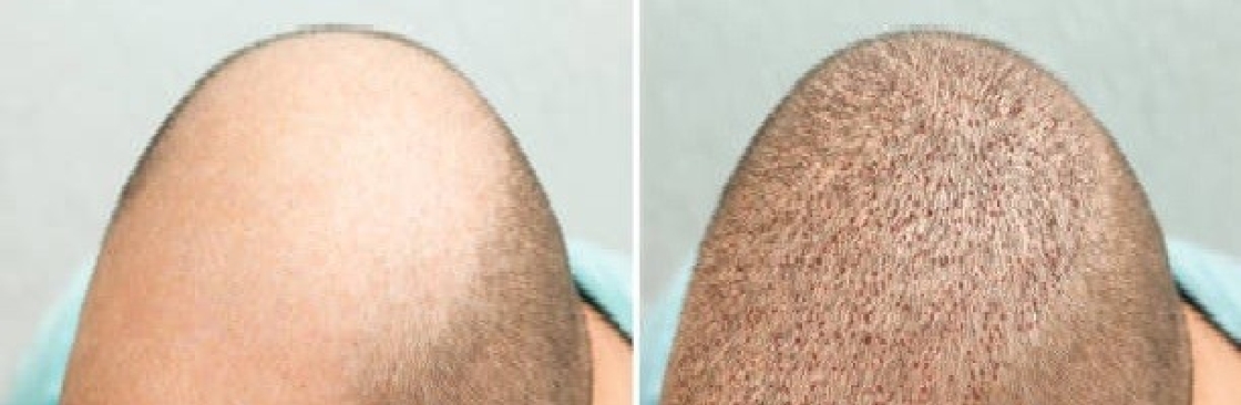 hairtransplant tr Cover Image