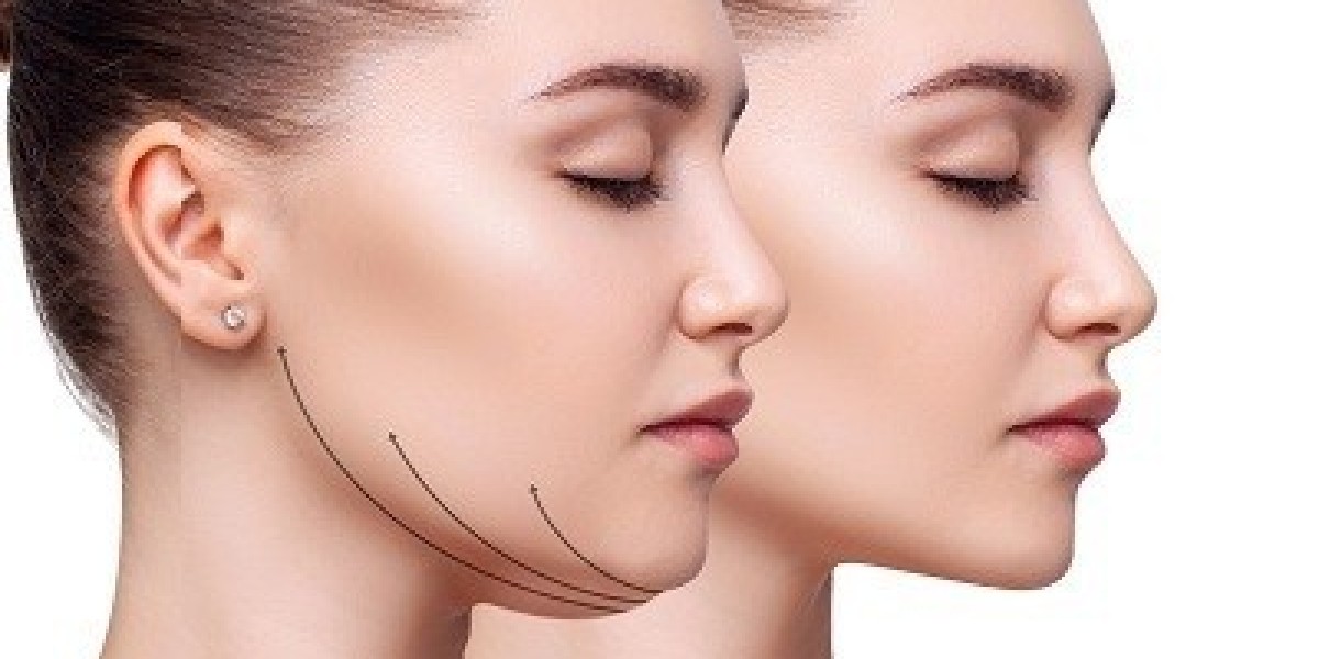 Double Chin Removal in Islamabad: A Comprehensive Guide to Reclaiming Your Confidence
