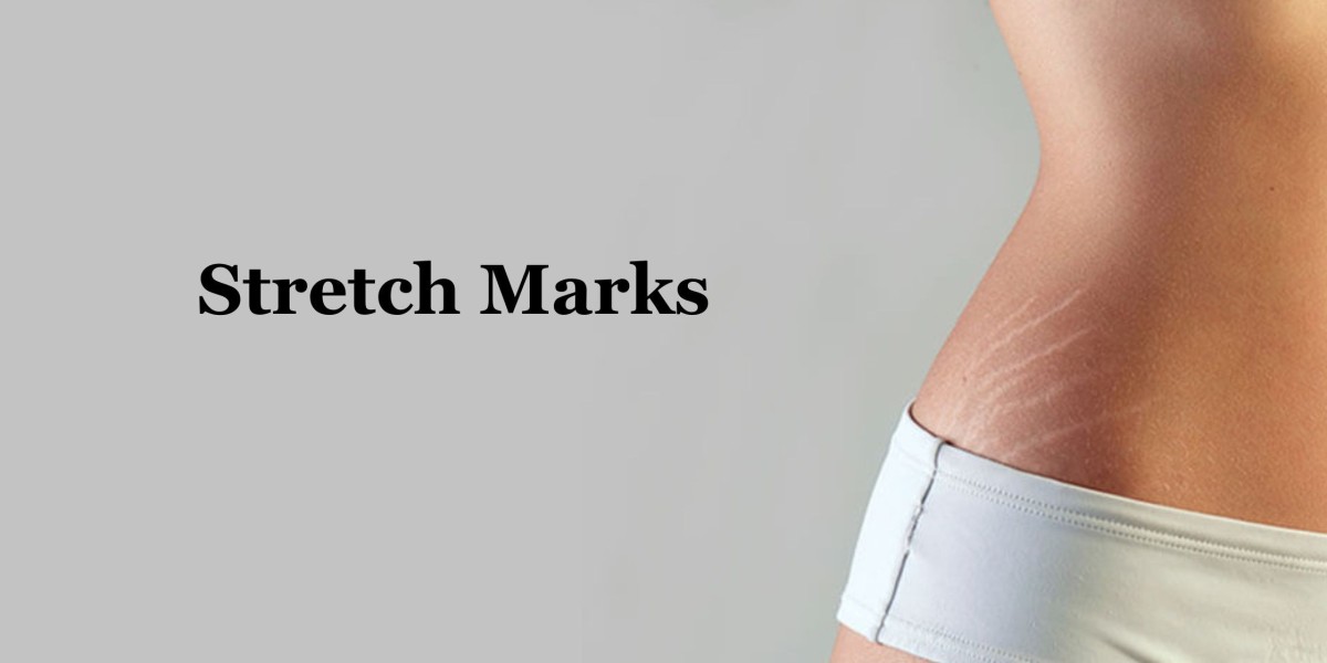 Stretch Marks After Pregnancy: 4 Tips For Removing Them?