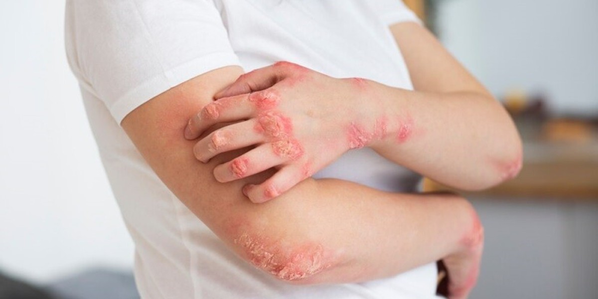 Can Nummular Eczema Be Treated with Homeopathy?