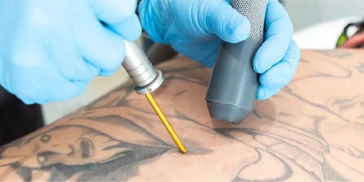 Laser Fading Trend: Tattoo Removal Market Boom in Japan, South Korea, UK & Australia