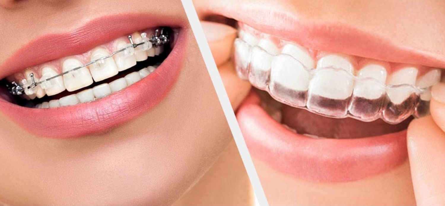 A Comprehensive Guide to the Different Phases of Orthodontic Care – Telegraph