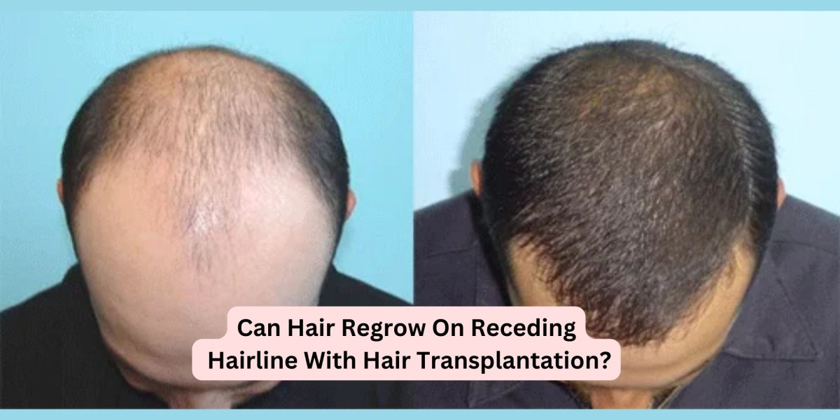 Can Hair Regrow On Receding Hairline With Hair Transplantation?
