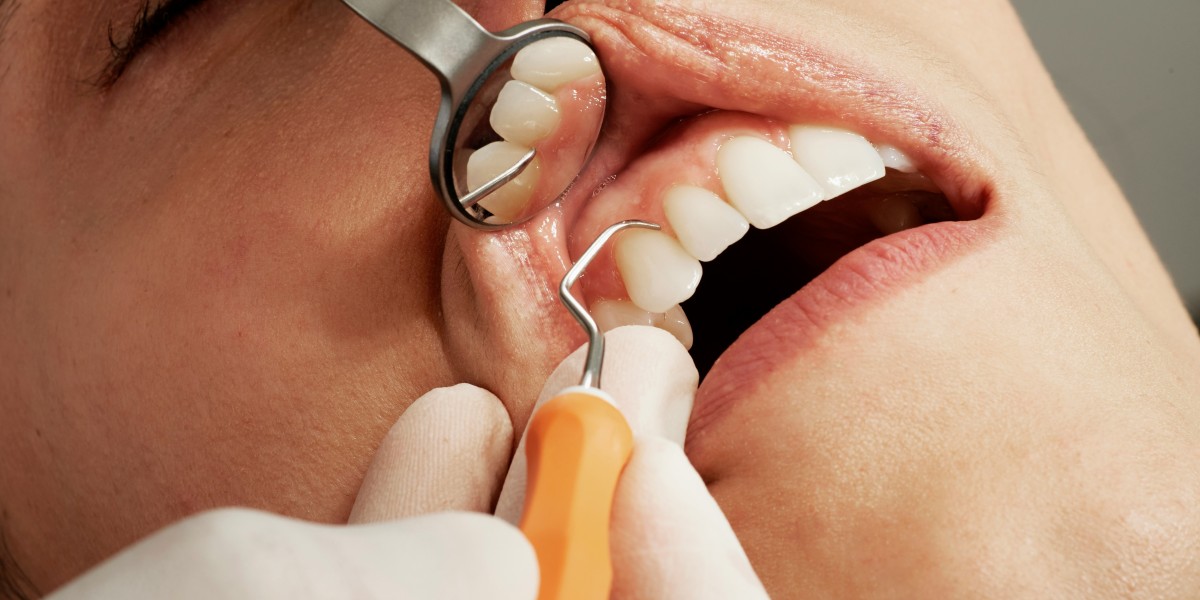 Enhancing Your Smile: Exploring Dental Veneers and Dental Implants