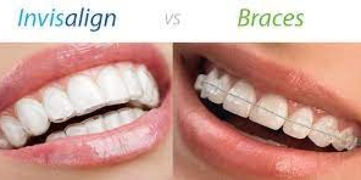 Exploring Invisalign Treatment: A Comprehensive Guide for Patients in the UK