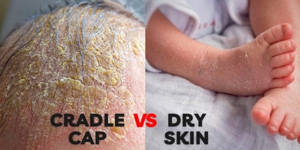 Moisturize or Medicate? A Parent's Guide to Cradle Cap vs. Dry Skin