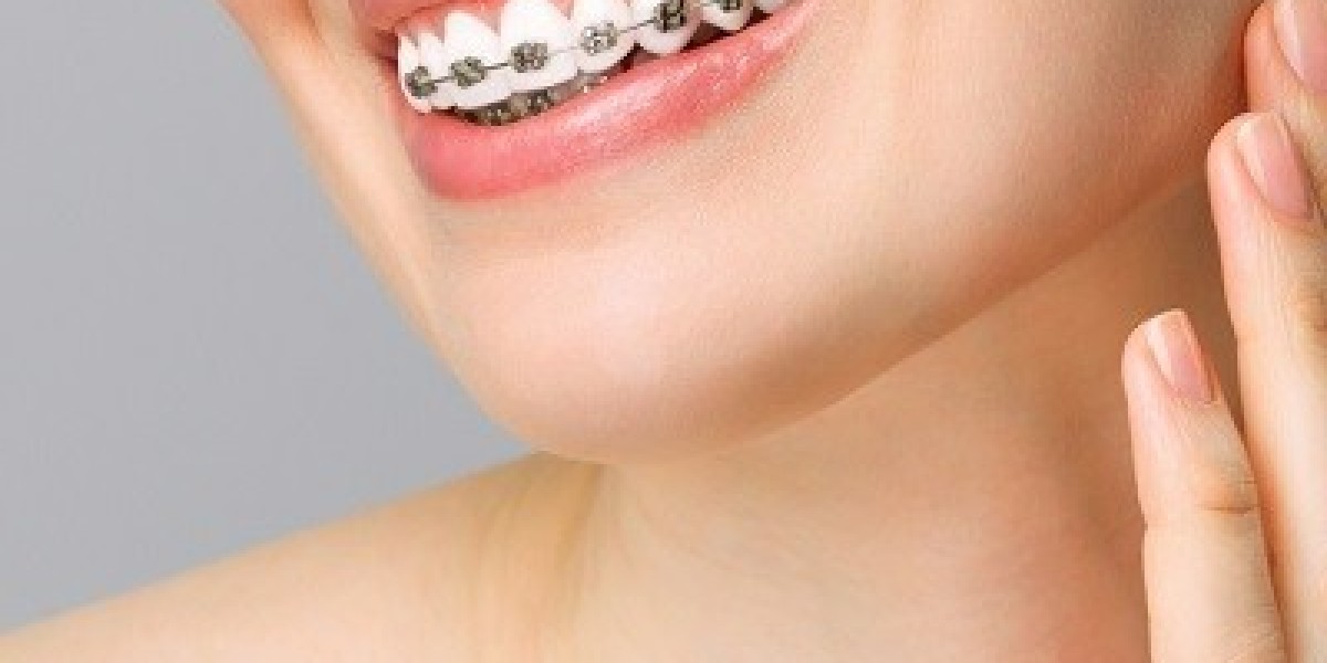 Smiling Brighter: A Guide to Understanding Dental Braces