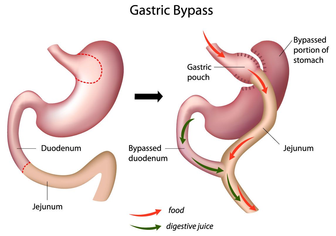 Mini Gastric Byp**** Surgeon in Punjab | Gastric Byp**** Surgery