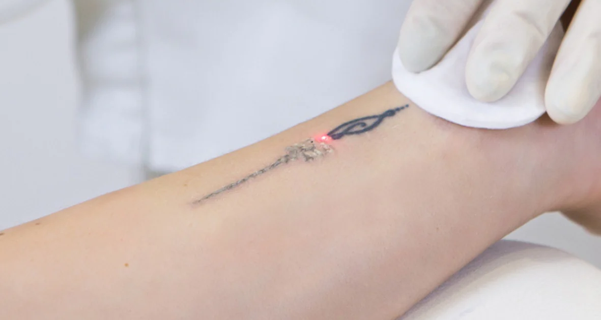 Say Goodbye to Unwanted Ink with Laser Tattoo Removal Services