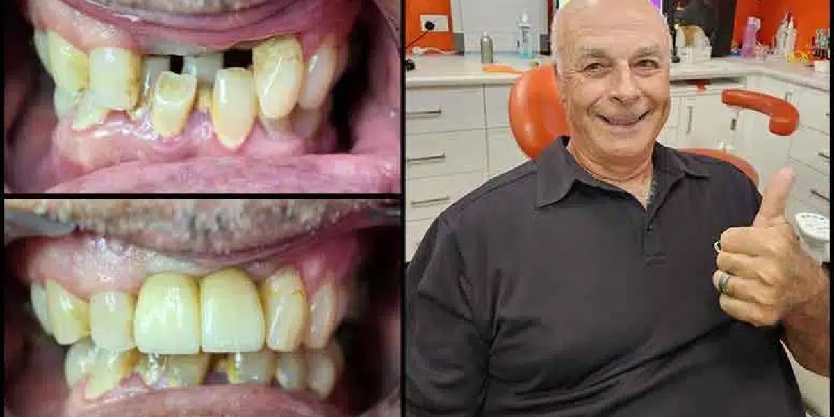 Accessible Smiles: Affordable Dental Implants on the Sunshine Coast