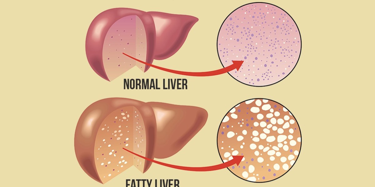 Fatty Liver Herbal Treatment with Ayurvedic Remedies
