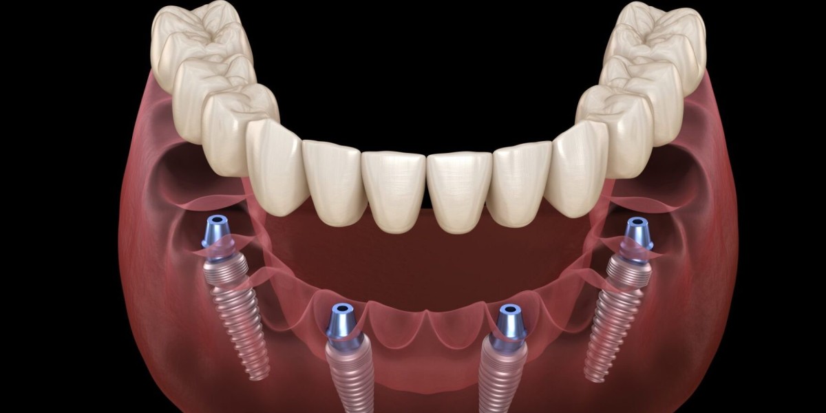Dental Implants: The Ultimate Solution for Tooth Replacement