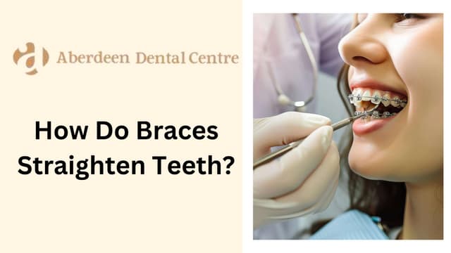 How Do Braces Straighten Teeth? | PPT