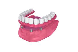 Overdentures - Bridgeport Aesthetic Dentistry