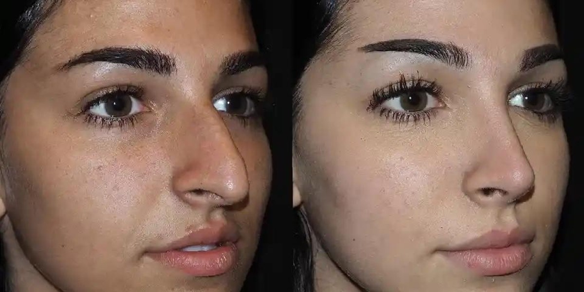 Revision Rhinoplasty Success Story: Achieving My Desired Outcome