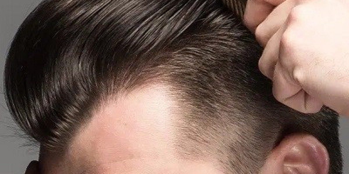 FUE Hair Transplant: Is It Right for You?