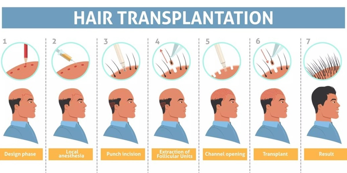 Unlock Your Confidence: How FUE Hair Transplants Can Change Your Life
