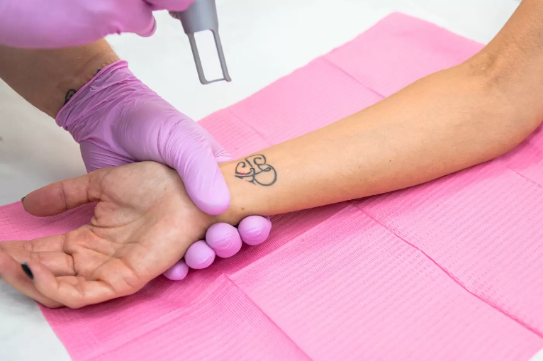 When To Stop Tattoo Removal Treatment | Bianco Beauty