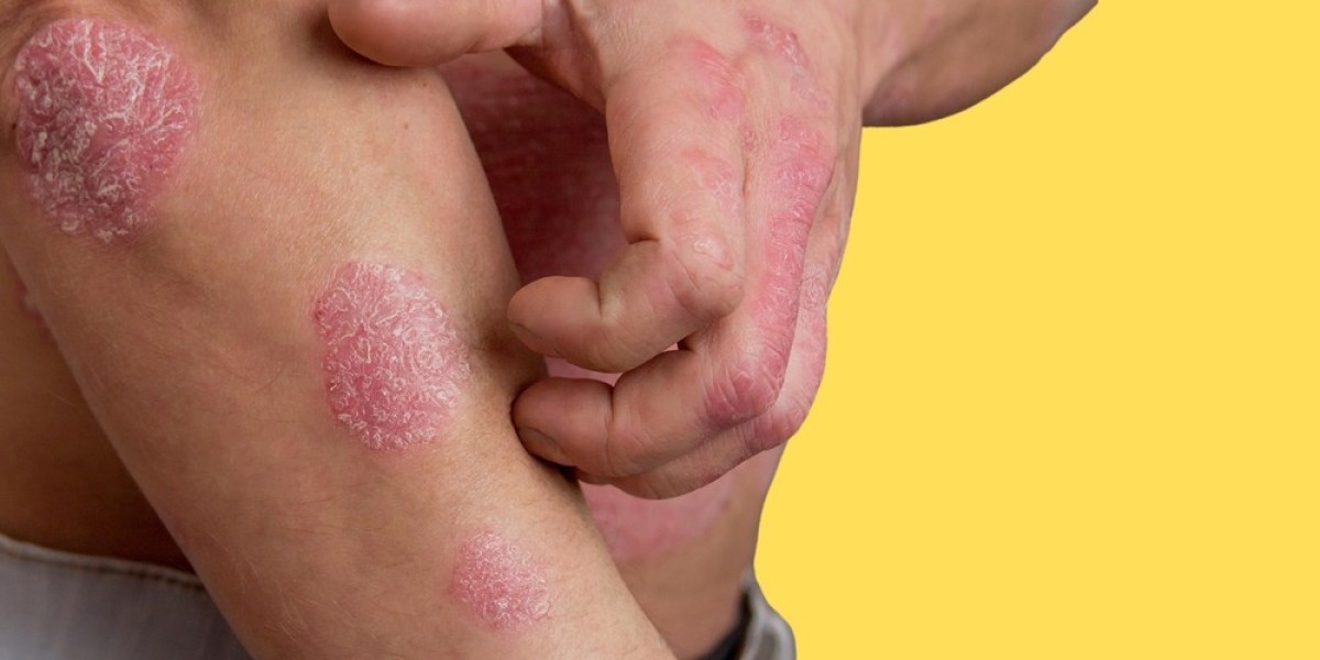 Nummular Eczema: What You Need to Know for Effective Care