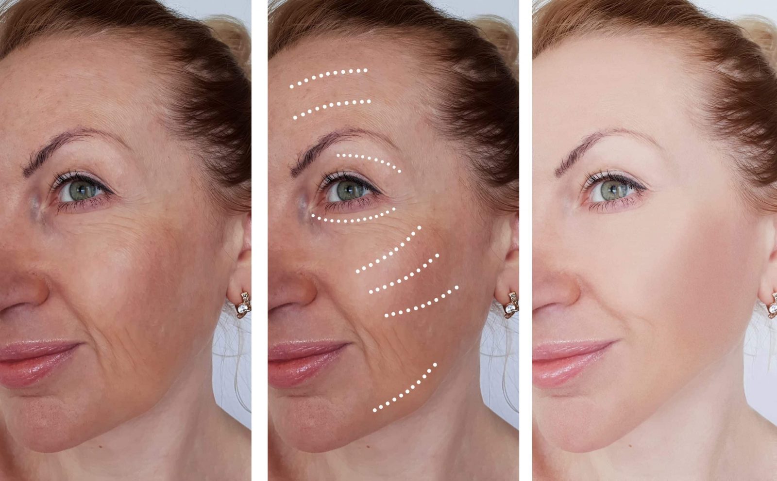 Liquid Facelift Can Be An Innovative Way For Your Face Rejuvenation | Article Terrain