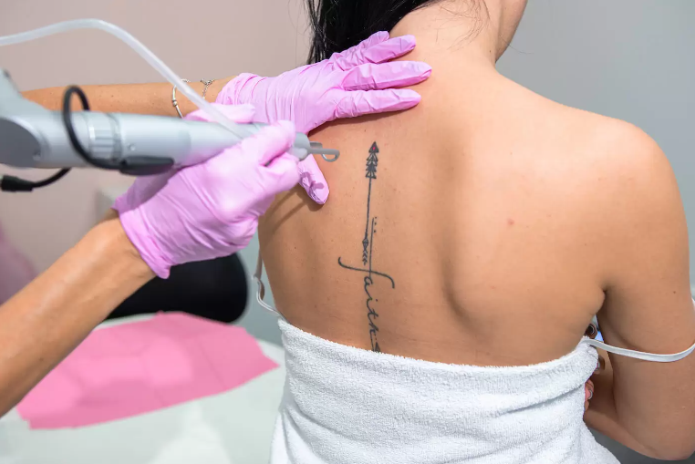 Is Laser Tattoo Removal Safe for Skin? How to Make it Safe