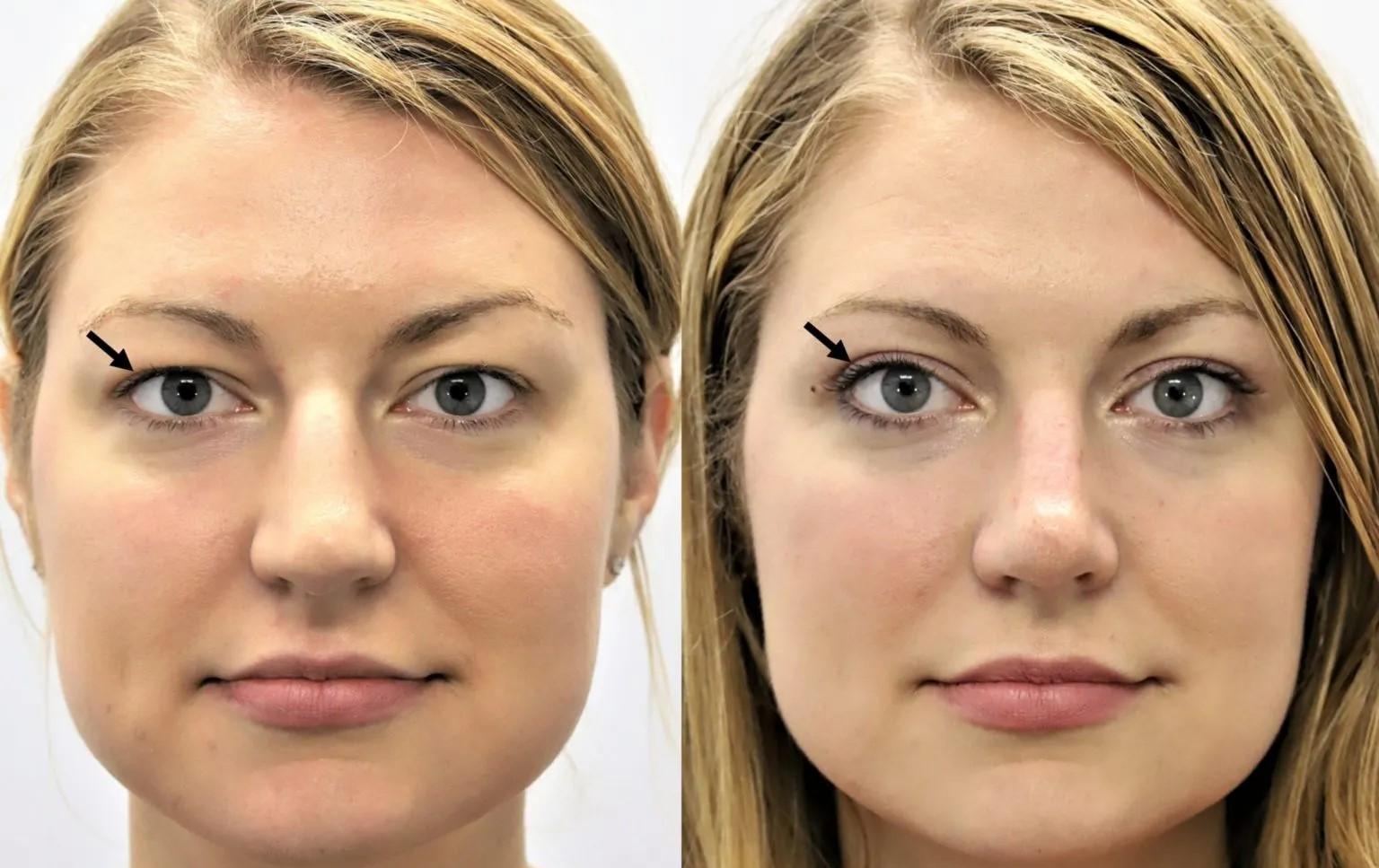 Getting to Know the Procedure for bovenooglidcorrectie (upper eyelid correction) - FORTUNE BUSINESS NEWS
