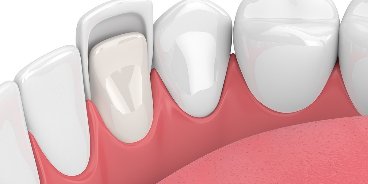 Understanding Dental Veneers: Enhancing Your Smile with Precision