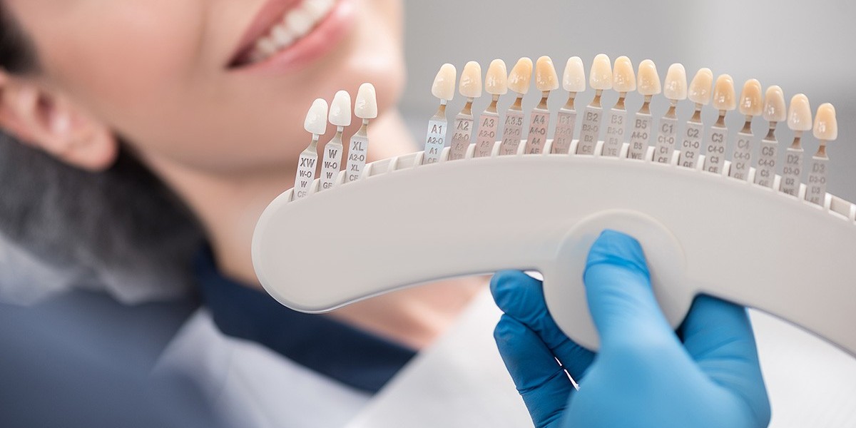 Transform Your Smile: The Ultimate Guide to Dental Veneers
