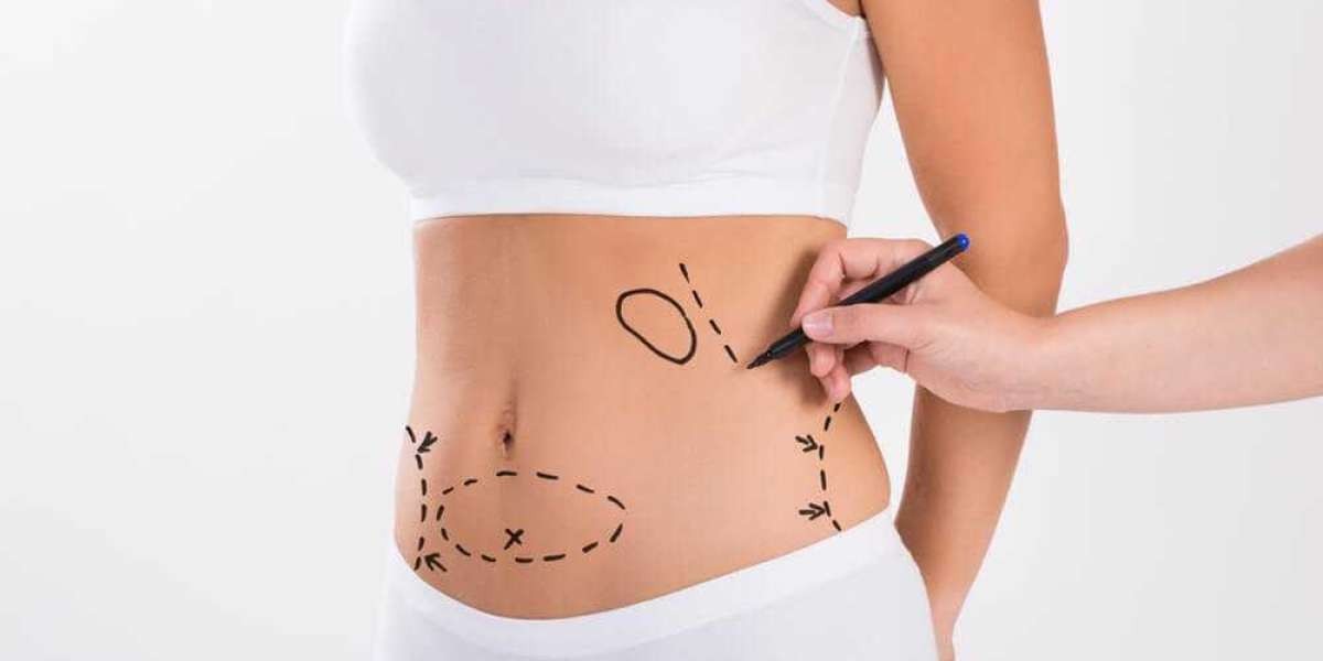 Top Clinics for Liposuction in Dubai: Your Path to a New You