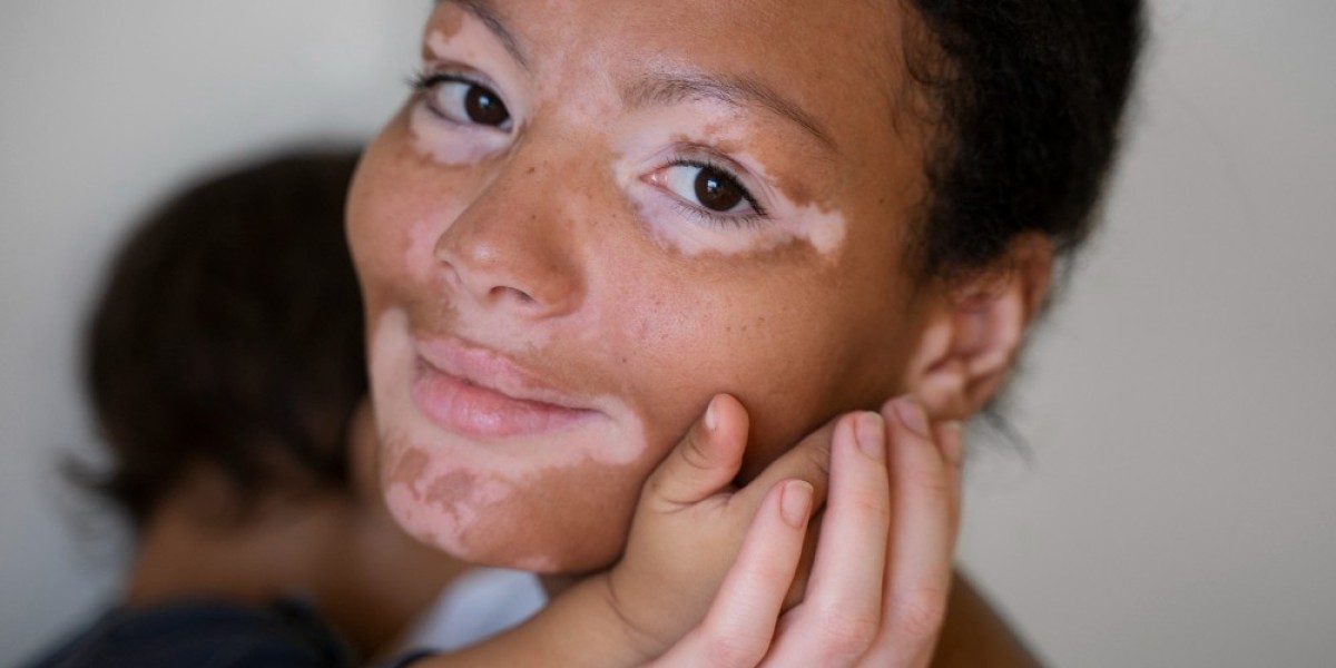Can Homeopathy Cure Vitiligo and What Are Its Causes?