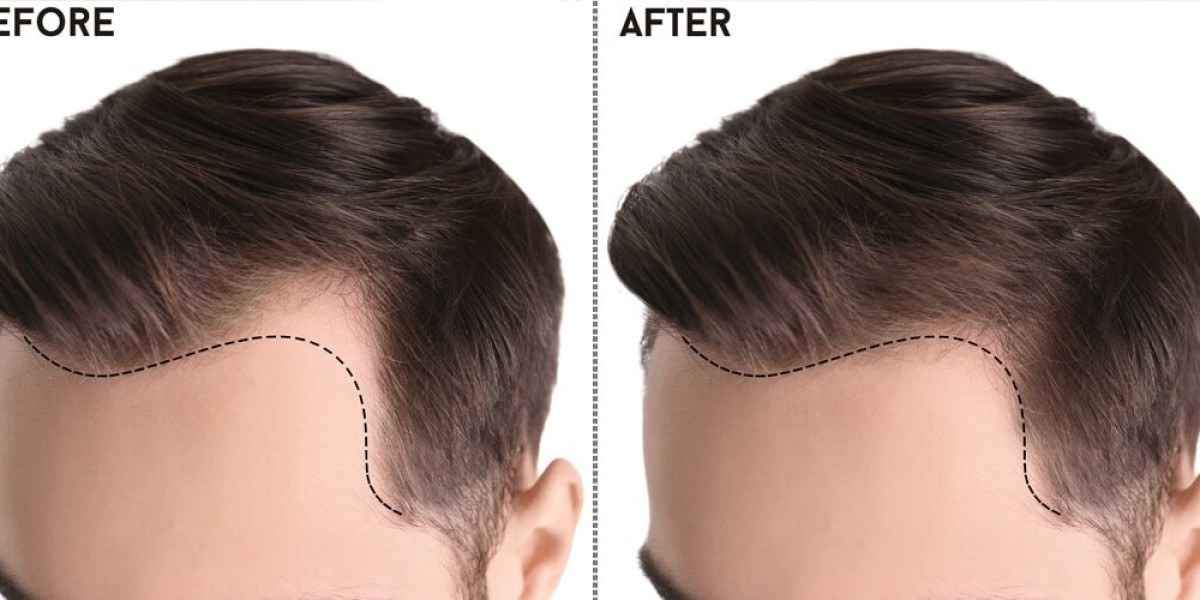 Unveiling Excellence: The Best Hair Transplant Clinics in Pakistan
