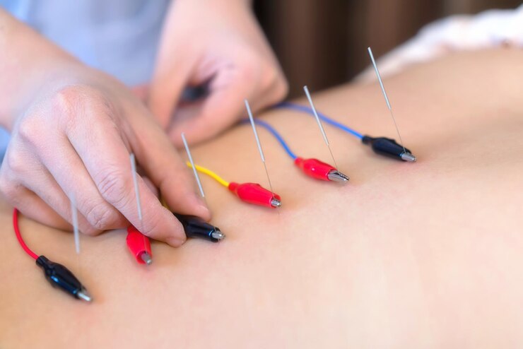 Pain-Free Acupuncture Slimming Methods to Lose Weight