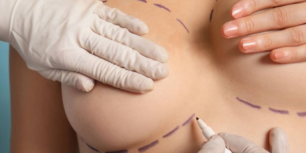 Enhancing Cleavage with Breast Enhancement Fat Transfer