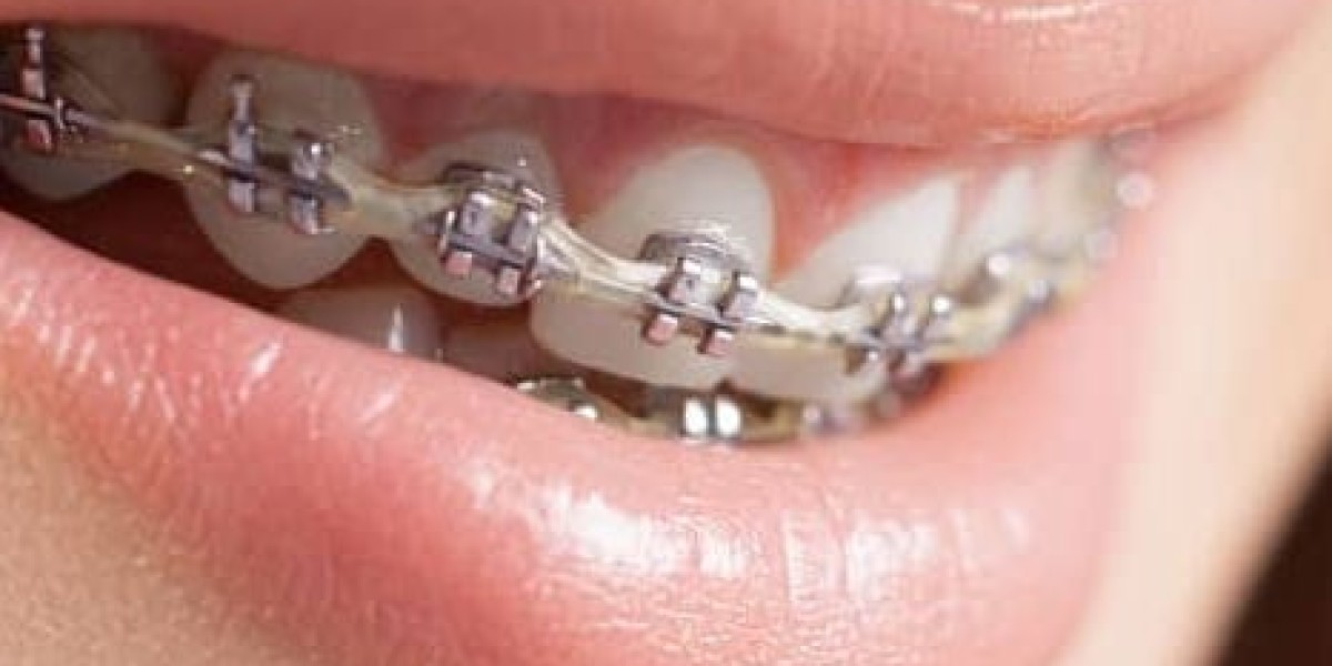 Price Trends: What to Expect When Getting Teeth Braces in Dubai